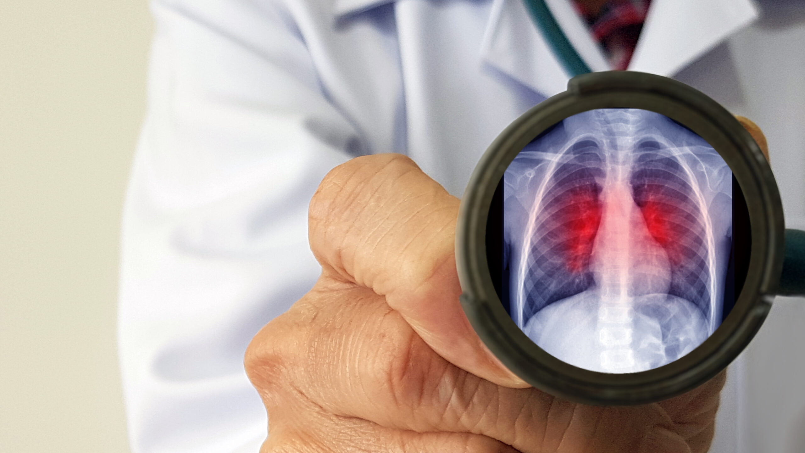 pneumonia